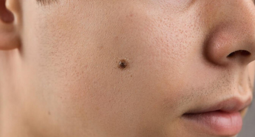 Значение родинок разных размеров на щеке: трактовка отметин на правой и левой стороне